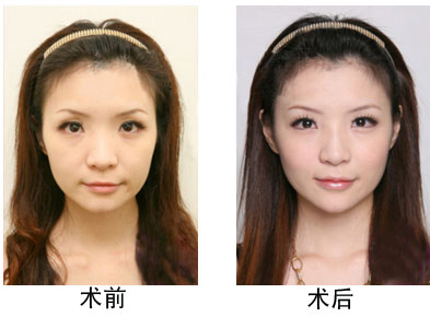 下颌角去除手术价格