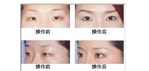 磨皮去痘坑多少钱