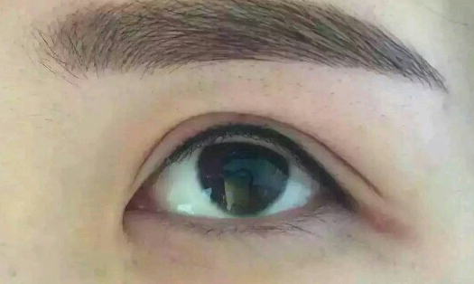 光纤溶脂瘦手臂