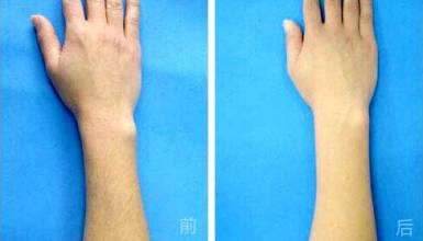 络腮胡脱毛有效果吗
