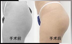 双眼皮肿眼泡抽脂