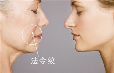 厚唇变薄术效果