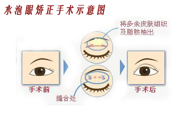 皮秒能去痘坑吗