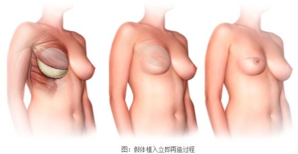 超声溶脂瘦手臂治疗后需要节食或者是增加运动吗
