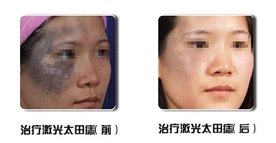 吸脂瘦手臂术后会反弹吗
