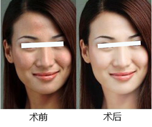 去痘坑凹洞最有效方法?