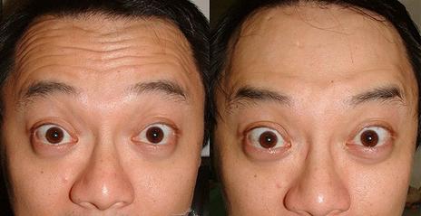 光子嫩肤美白有后遗症吗