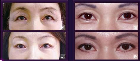 手术去抬头纹的价格