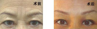 激光去抬头纹安全吗