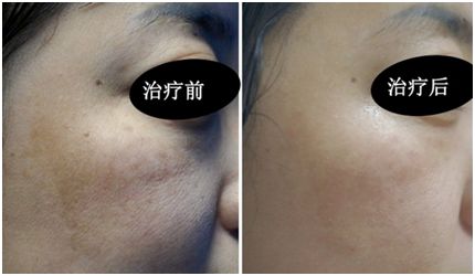 改发际线手术多少钱