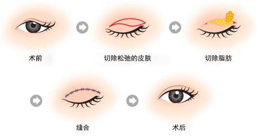 鼻部做垫鼻子后如何进行护理保养
