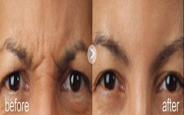 激光去痘坑多少钱
