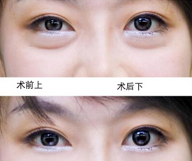 做韩式开眼角痛不痛啊