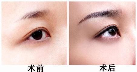 面部用光纤溶脂效果好吗
