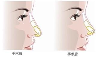 韩式无痕开眼角怎么恢复
