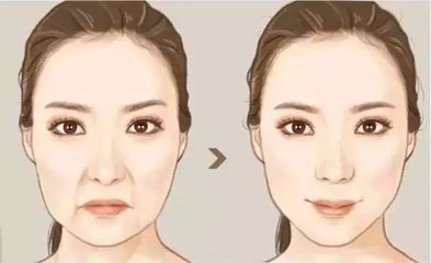 肿眼泡能割双眼皮么