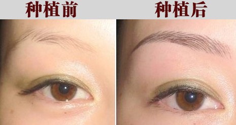 阴道紧缩术需要多少钱