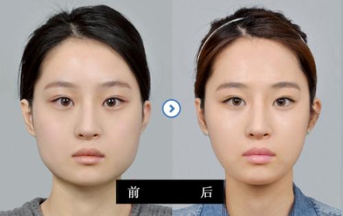 做了开眼角手术后要注意什么呢,怎么护理