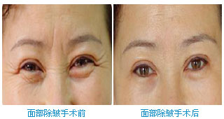做韩式开眼角需要多少钱